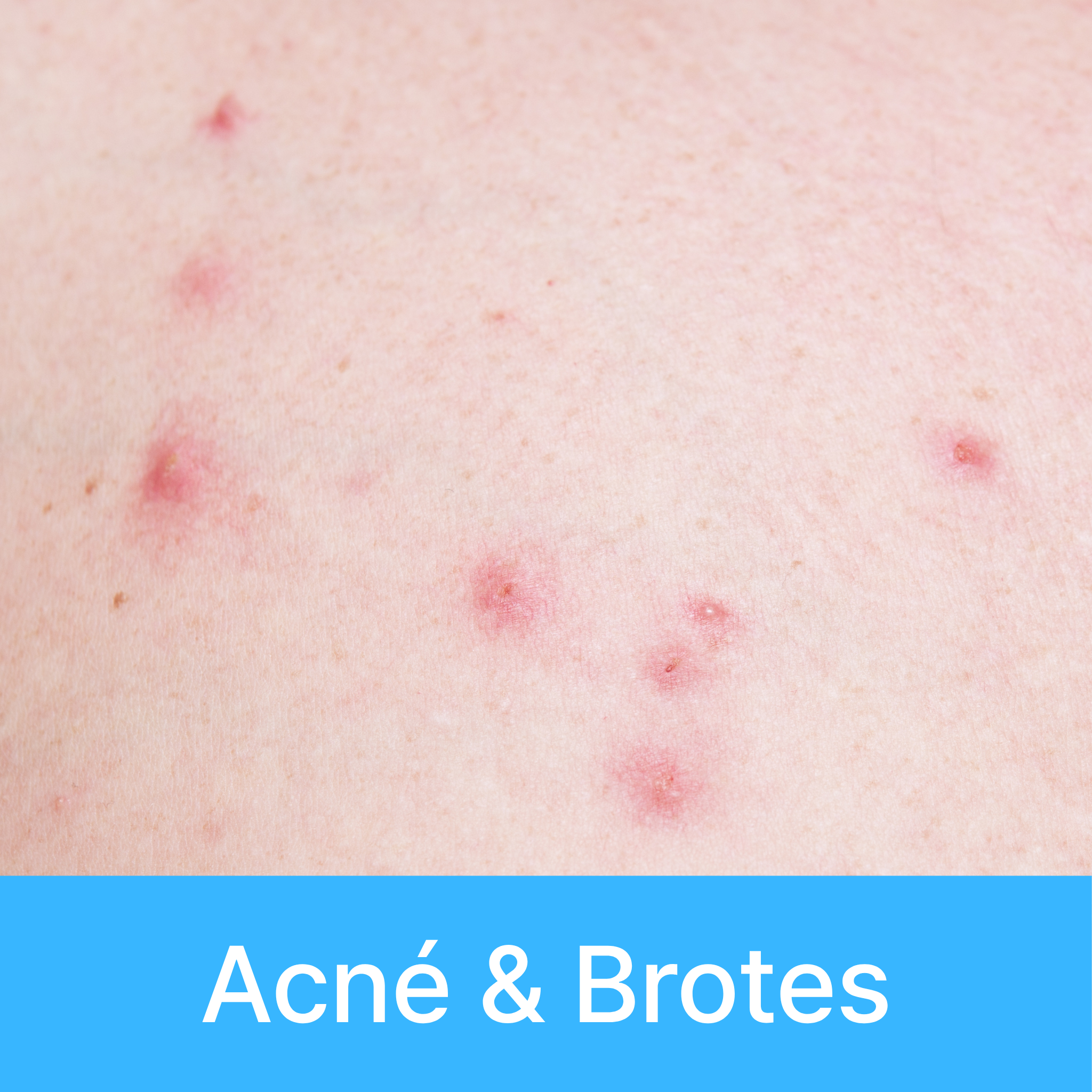 Acné & Brotes
