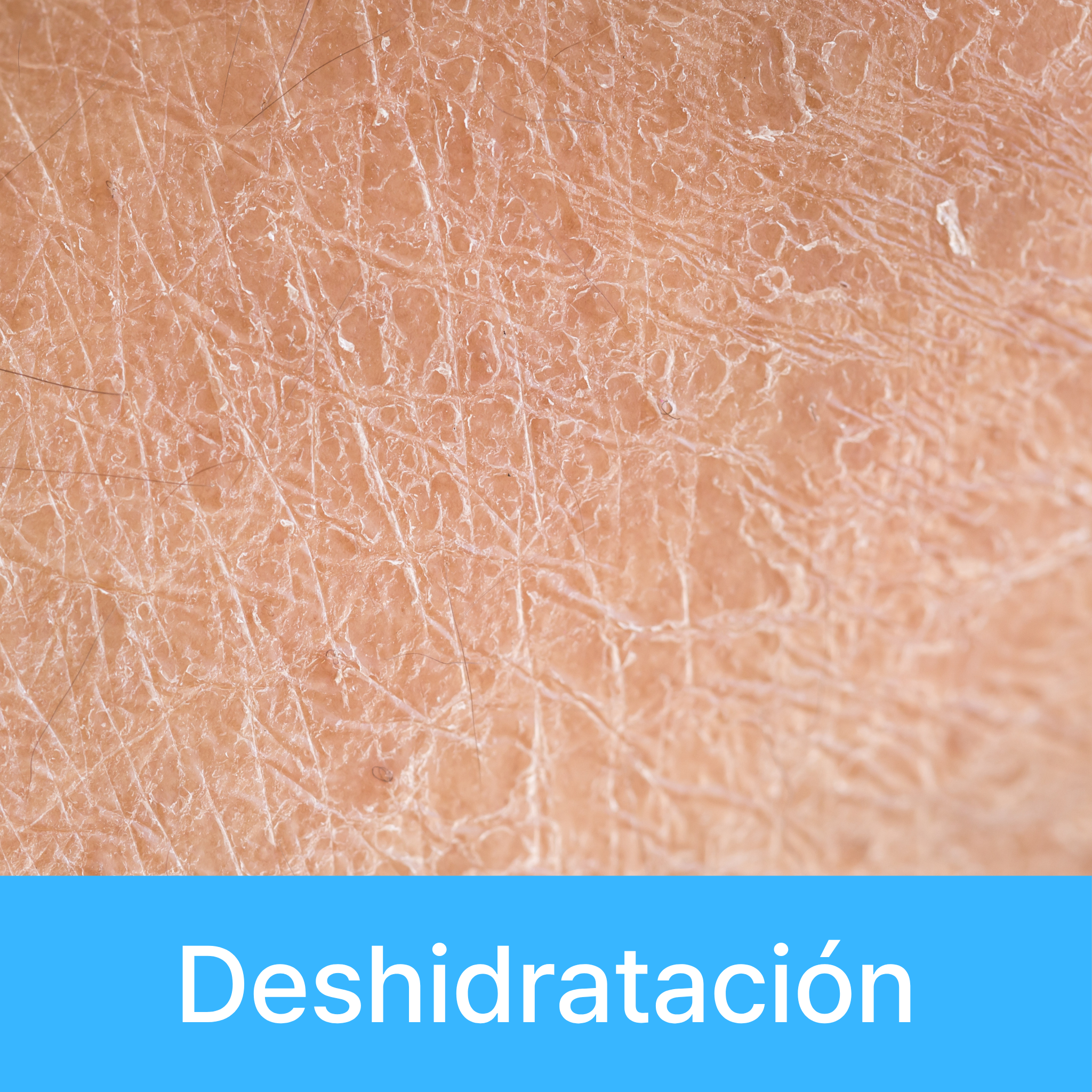 Preocupaciones.Deshidratación